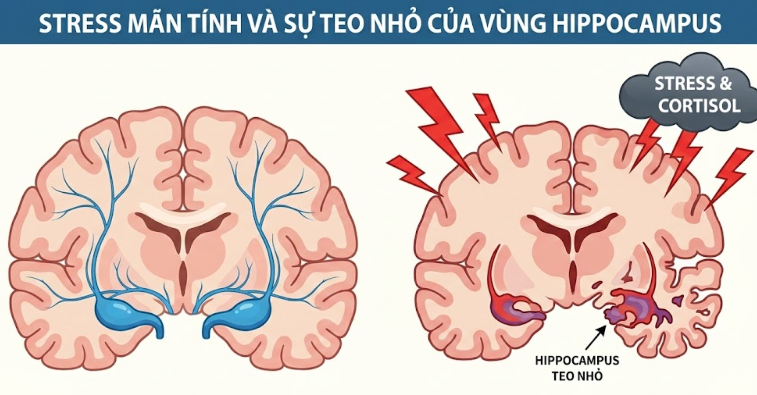 Stress mãn tính và sự teo nhỏ của vùng hippocampus